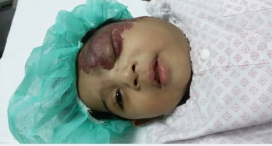 الإهمال الطبي عرض مستمر.. جهاز الشفط يشوه مولودة ويصيبها بالعمى