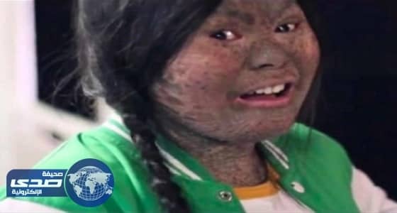 مرض وراثي نادر يحول فتاة لأفعى