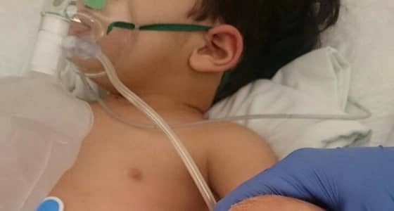 ماء النار ينهش لحم طفل عمره عامين في الأحساء