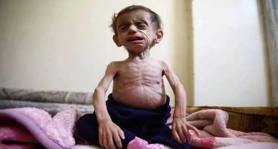 تنديد أممي حقوقي بمجاعة الغوطة في دمشق