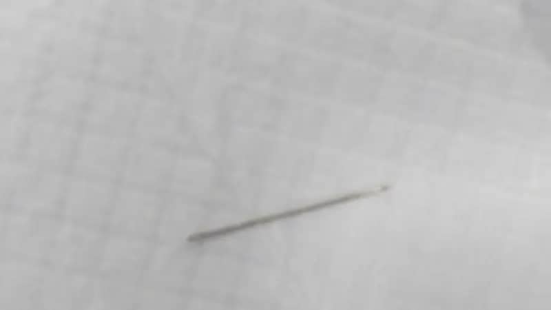 "فريق طبي" ينجح باستخراج إبرة خياطة من بطن مريضة بتخصصي بريدة