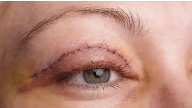 معلومات صادمة حول عملية شد الجفون.. تعرفي عليها