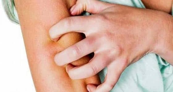 " المطلق " يحذر الآباء من الوقوع في الإثم مع انتشار الجرب