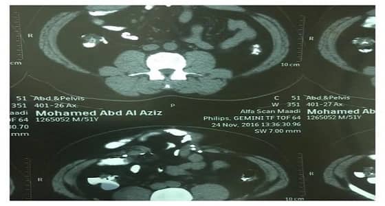 فريق طبي ينجح في اجراء عملية جراحية معقدة في مستشفى الفيصل