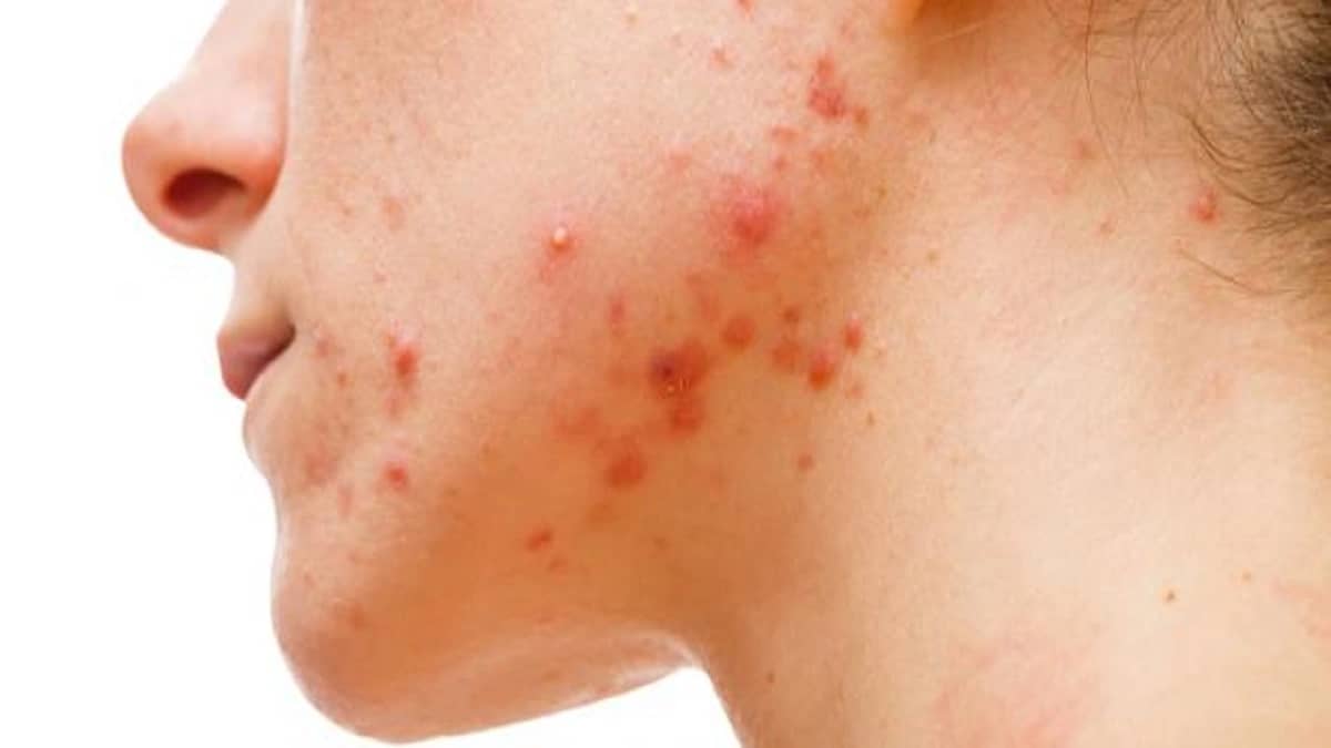 أشياء يجب تجنبها عند ظهور الحبوب في منطقة الفك