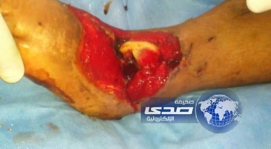 كسر مضاعف يجبر ثلاثينية للبقاء في المستشفى ثلاثة أشهر