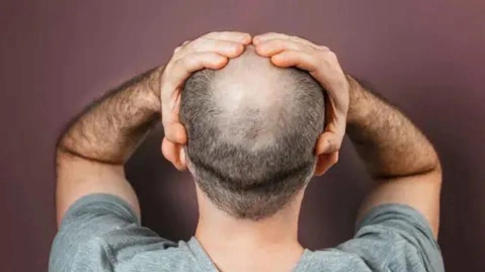 سيدة تقاضي زوجها لإخفاء صلعه عنها