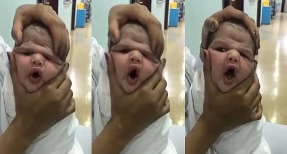 وزير الصحة يعتمد عقوبة ممرضات عبثن بطفل في الطائف