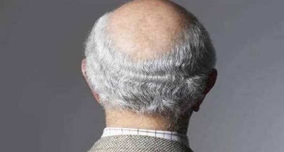 دراسات تكشف أسبابا غير متوقعة للصلع والشيب