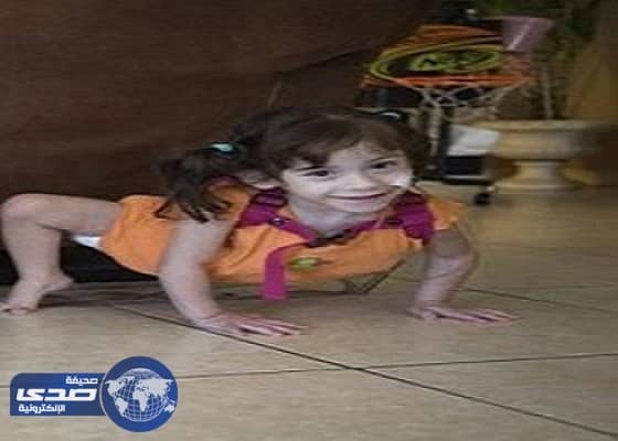 صور حديثة لطفلتين ولدتا بجسمين متلاصقين وخضعتا لعملية خطرة لفصلهما