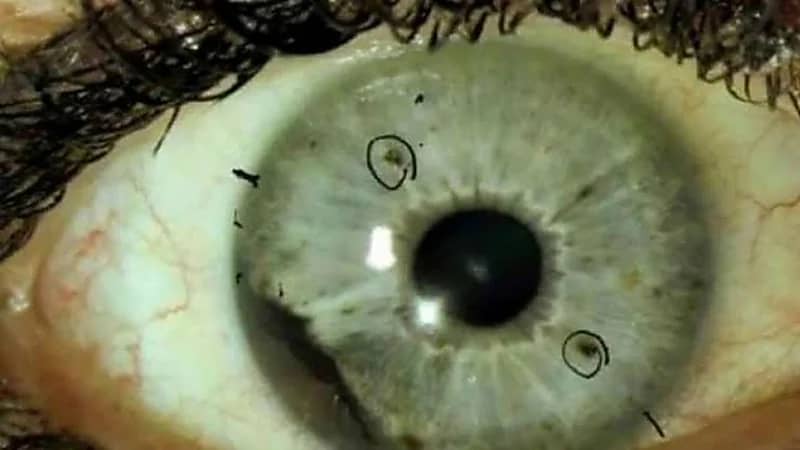 مصر تحذر من استخدام المضادات الحيوية بعد ظهور 3 إصابات بالفطر الأسود