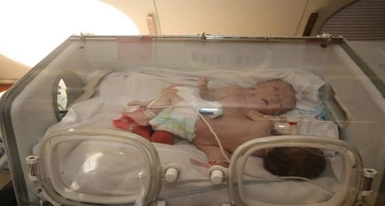 بالفيديو والصور.. نقل التوأم السيامي الفلسطيني حنين وفرح إلى المملكة لإجراء عملية الفصل