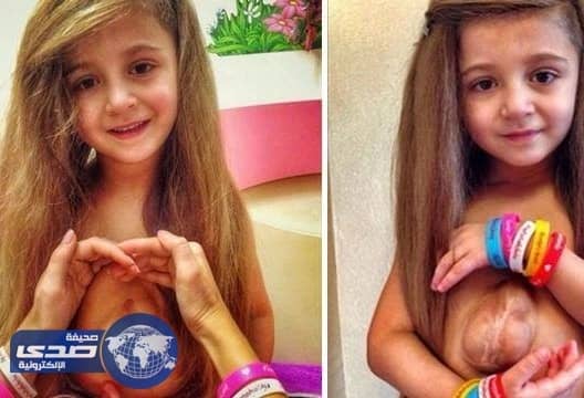 بالفيديو.. طفلة تتحدى الطب وتعيش بقلب خارج صدرها