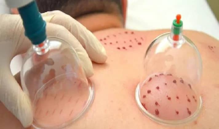 بالفيديو .. حكم الحجامة في نهار رمضان