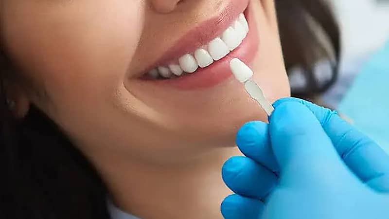 استشاري : عدسات الأسنان ليست مناسبة لكل الأشخاص ..فيديو